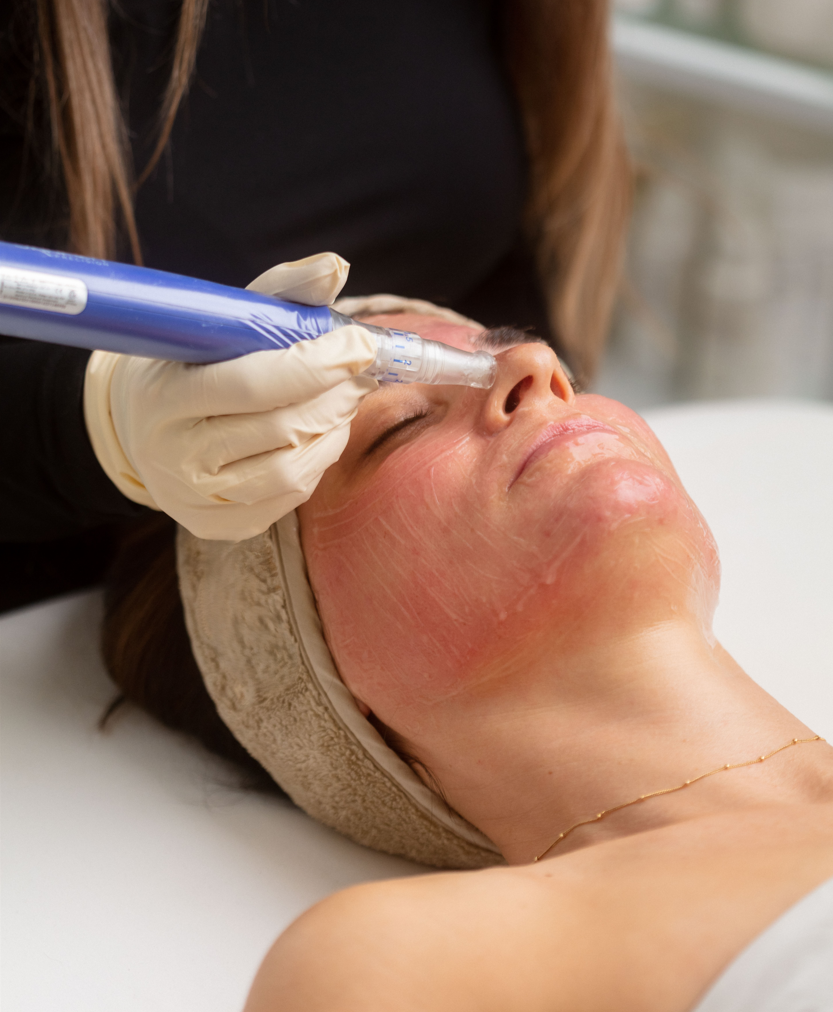 TOP 5 TREATMENTS TO START NOW TO PREP YOUR SKIN FOR SUMMER